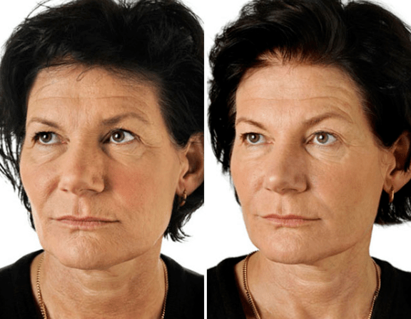 Das Ergebnis der fraktionalen Verjüngung des Gesichts