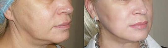 Foto nach Anwendung des Verfahrens