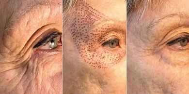 Fotos vor und nach der Plasma-Hautverjüngung.