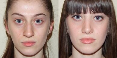Vor und nach der Plasma-Hautverjüngung.